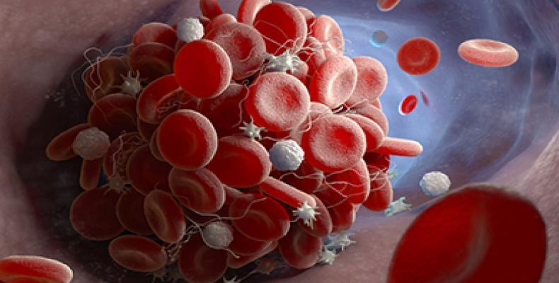 COVID-19 triggers hyperactivity in platelets leading to the formation of more blood clots in some patients. Photo credit: Getty Images COVID-19 triggers hyperactivity in platelets leading to the formation of more blood clots in some patients. Photo credit: Getty Images