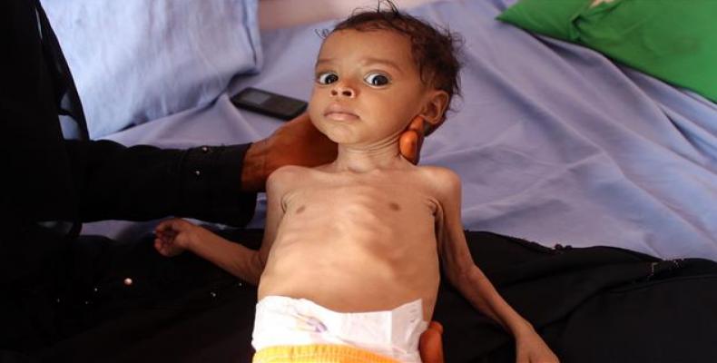 A malnourished Yemeni toddler at a clinic in the port city of Hudaydah. (Photo: AFP)