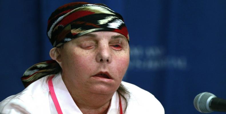 Carmen Blandin Tarleton, tras recibir el primer trasplante de cara, en el Hospital Brigham and Women's, Boston, EE.UU., el 1 de mayo de 2013.Charles Krupa / AP